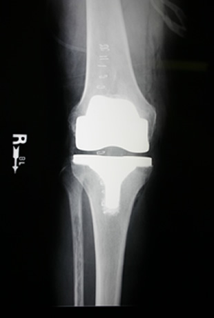knee replacement implant x-ray