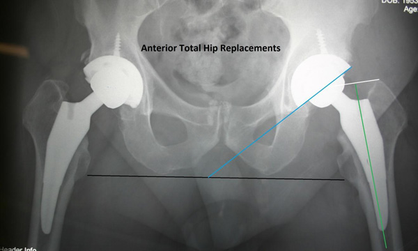 What should you expect during a full hip arthroplasty?