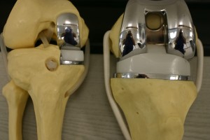 Uni Knee vs. Total Knee