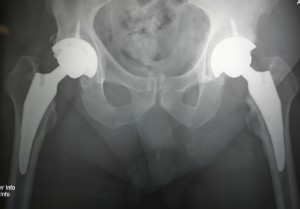 Bilateral anteriortotal hip replacement can be done on the same day with rapid recovery!