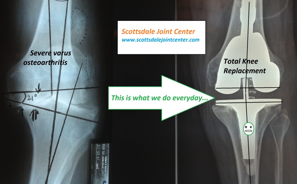 Total Knee SJC Scottsdale Joint Center