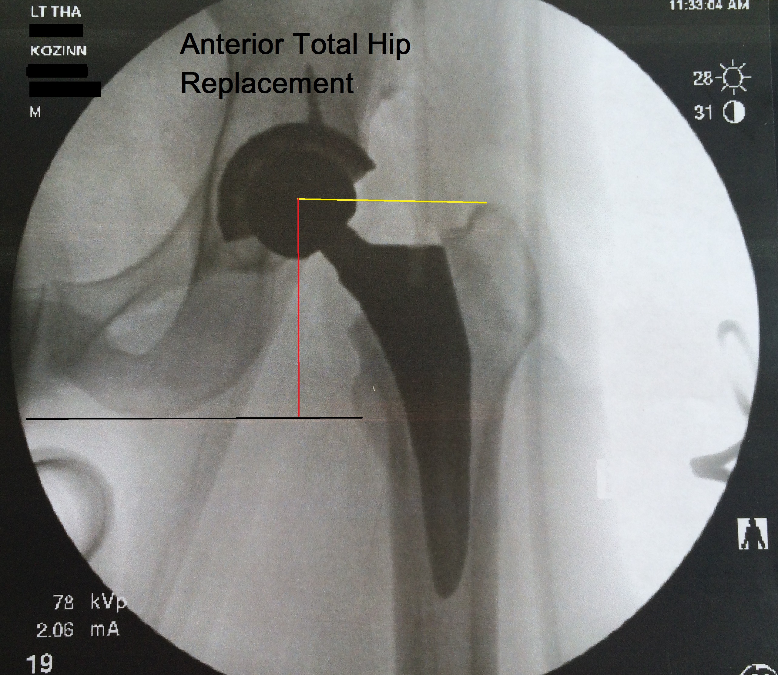 How can you minimize your recovery time from hip surgery?