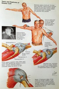 rotator cuff tears are VERY common... they can be fixed with minimally invasive arthroscopic techniques