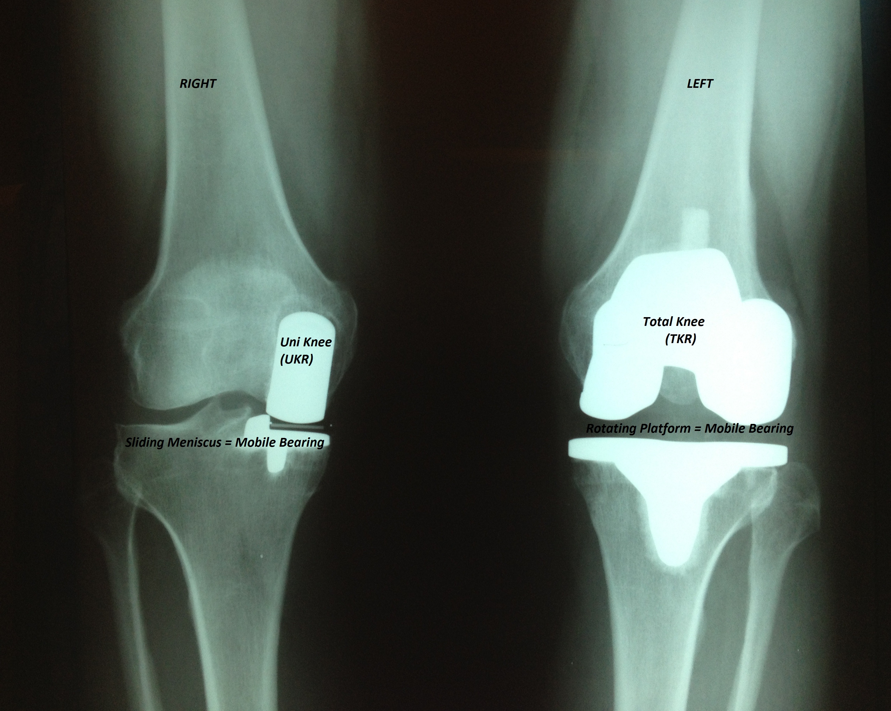 total knee arthroplasty 2 essay Page 2 of 20 improving the value of primary total knee arthroplasty: the attune® knee system david a fisher, md david a fisher, md, is a board certified and fellowship trained orthopaedic surgeon who. total knee arthroplasty 2 essay Page 2 of 20 improving the value of primary total knee arthroplasty: the attune® knee system david a fisher, md david a fisher, md, is a board certified and fellowship trained orthopaedic surgeon who.